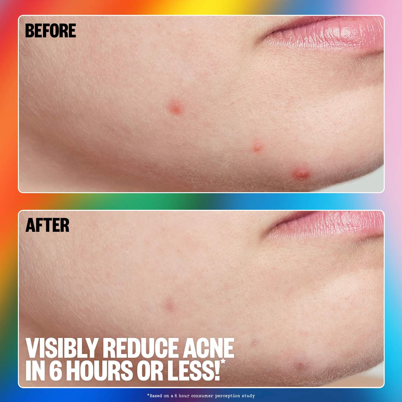 Pre orden: Peace Out | Salicylic Acid Acne Healing Dots | 16 Healing Dots / pack