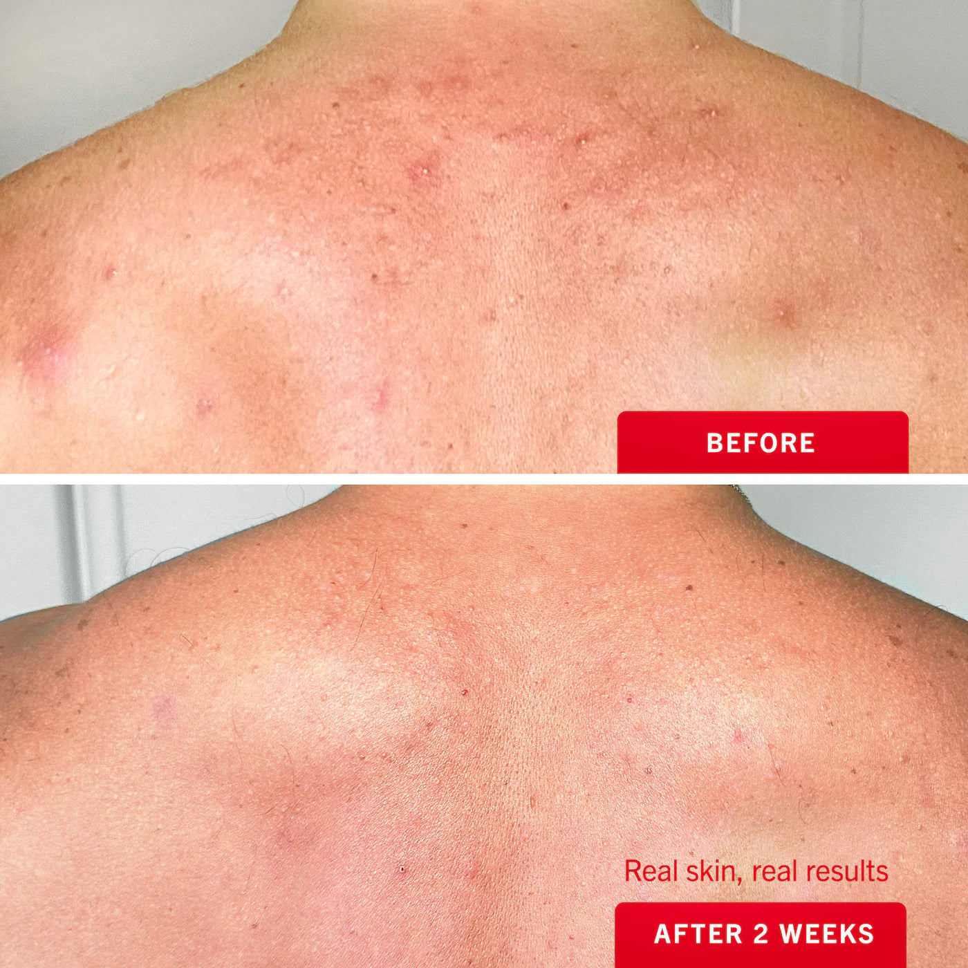 Pre-order: First Aid Beauty | Body Acne Clearing Mist - 2% Salicylic Acid Acne Treatment