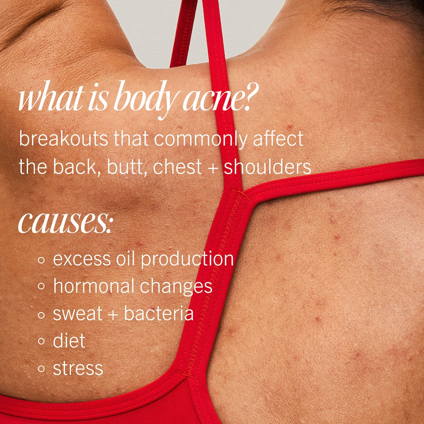 Pre-order: First Aid Beauty | Body Acne Clearing Mist - 2% Salicylic Acid Acne Treatment