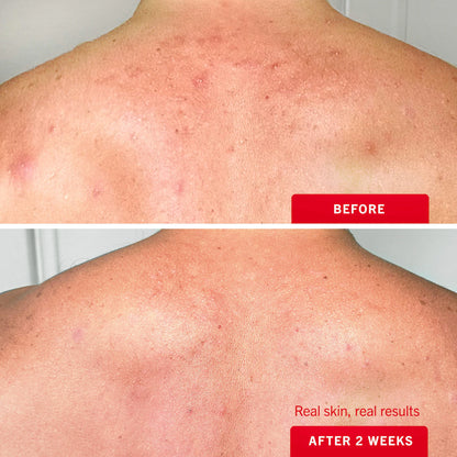 Pre-order: First Aid Beauty | Body Acne Clearing Mist  - 2% Salicylic Acid Acne Treatment